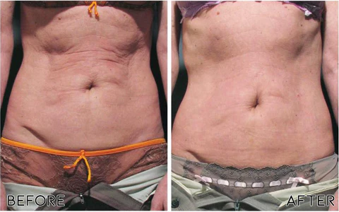 Oveallgo Avocado Ageless Body Cream Scrub