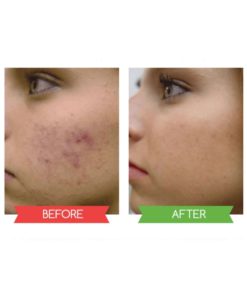 Black Mask  Peel off Mask