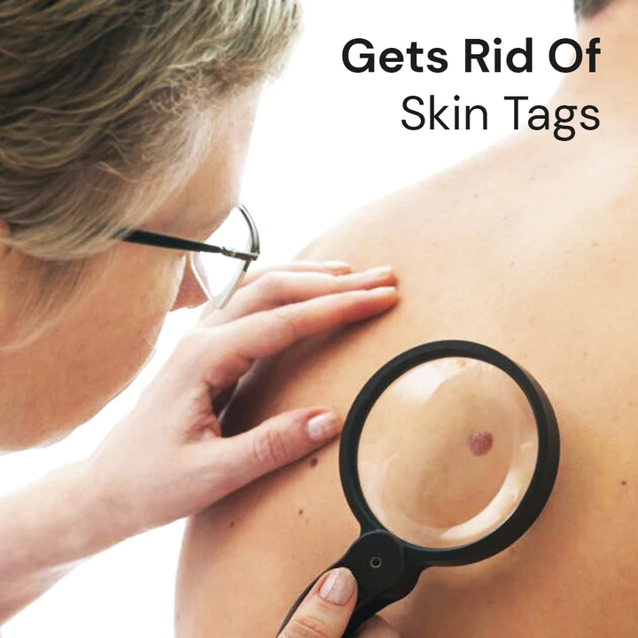 Oveallgo WartsOff NanoPURI Instant Blemish Removal Cream