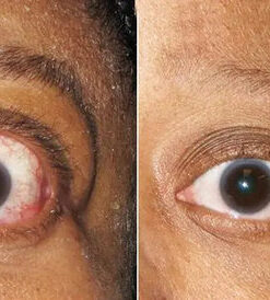 OnNopem Natural Organic Plant Eye And Dry Eye Spray