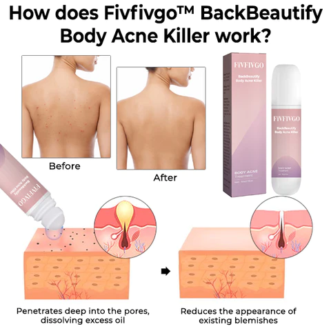 Fivfivgo BackBeautify Body Acne Killer