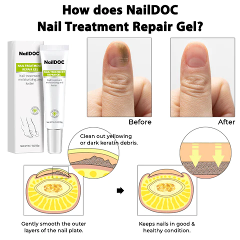 NARC Removal Paronychia Gel