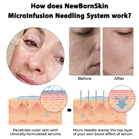 NewBornSkin MicroInfusion Needling System