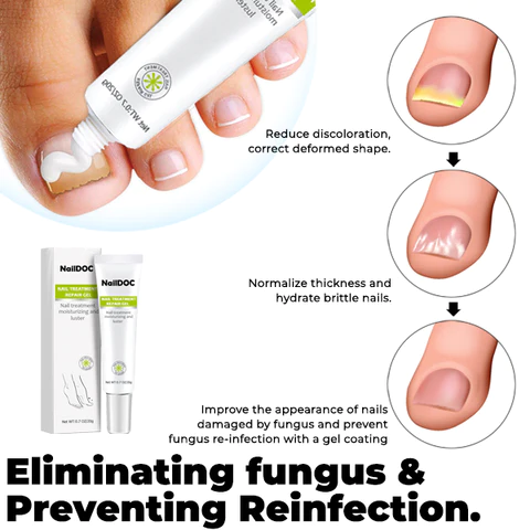 NARC Removal Paronychia Gel