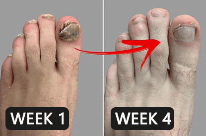 NailREBORN Antifungal  Professional Strength