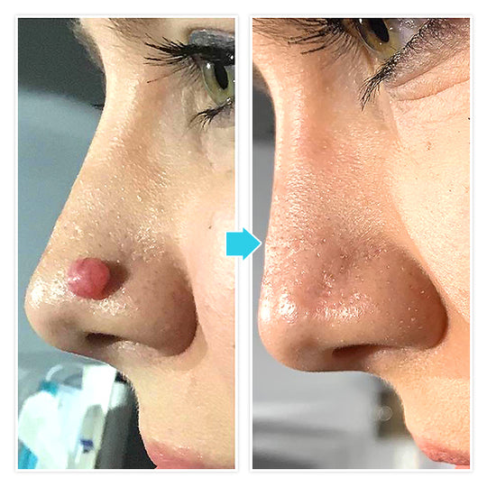 Auto-Micro Skin Tag Remover