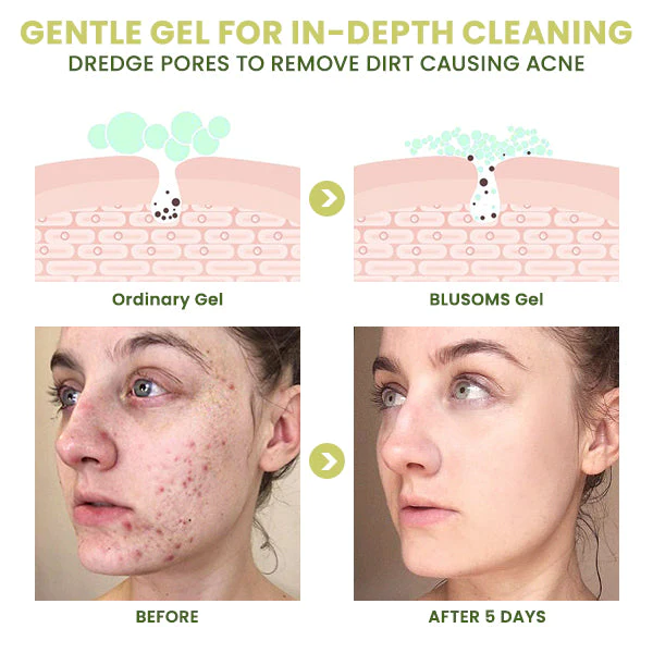 Fivfivgo ClearAcne Defense Gel