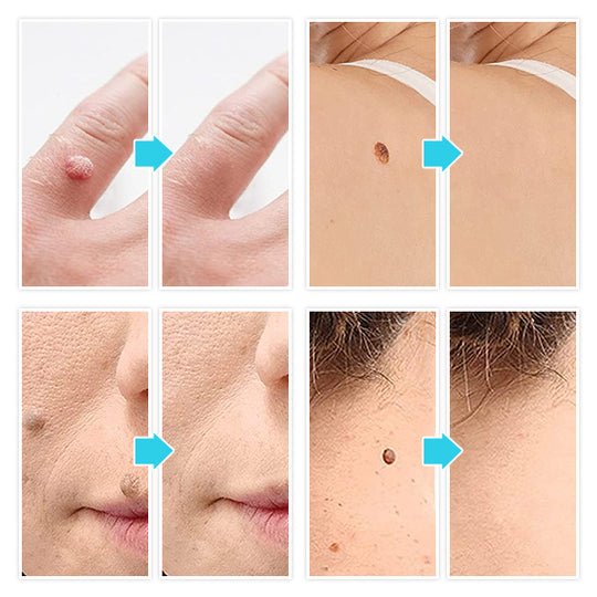 Auto-Micro Skin Tag Remover