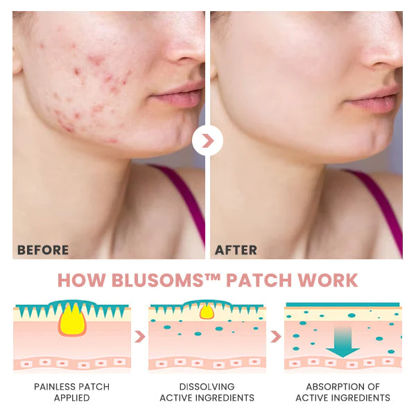 Blusoms Pro AcneAtelier Microneedles Patch