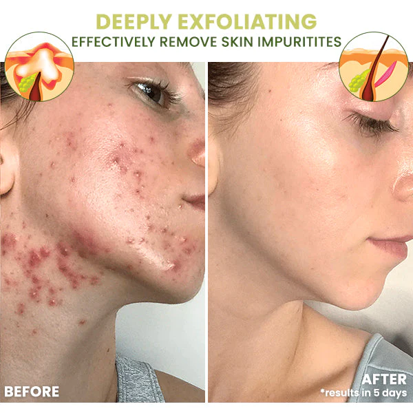 Fivfivgo ClearAcne Defense Gel