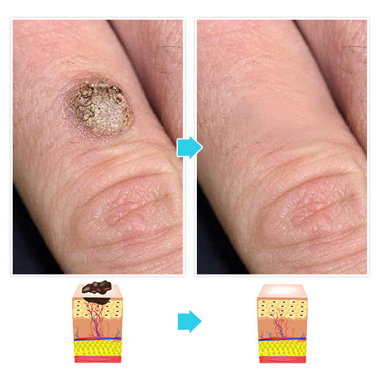 Auto-Micro Skin Tag Remover