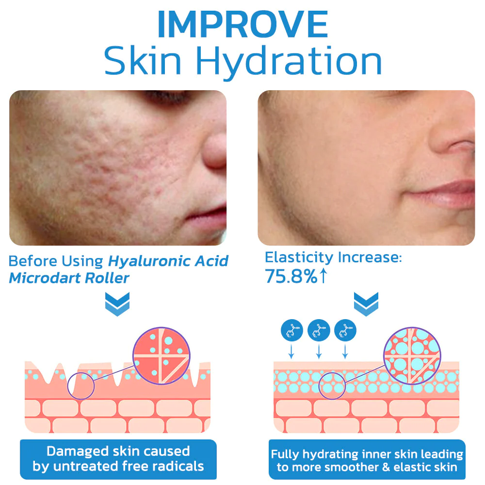 flysmus PockmarksHeal Hyaluronic Acid Microdart Roller