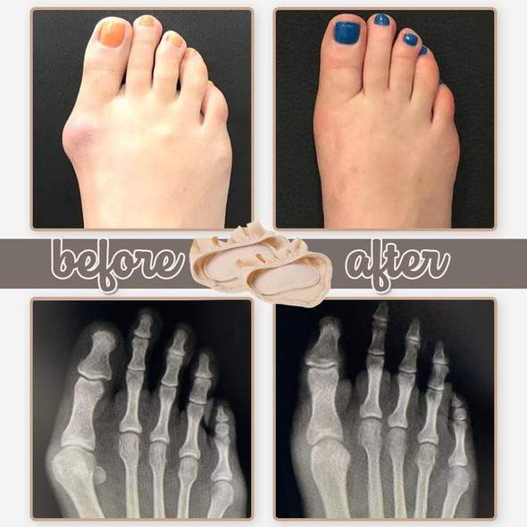 Honeycomb Fabric Forefoot Pads