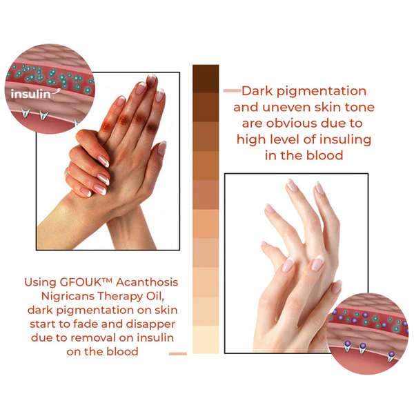 Zoviia Acanthosis Nigricans Therapy Oil