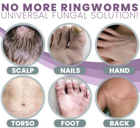 3 Days Anti Fungal Rash Cream