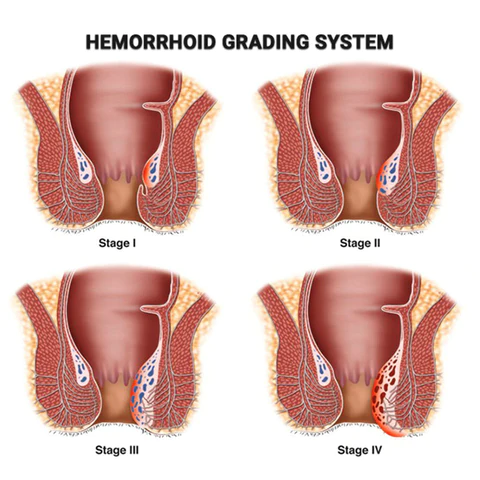 EAAYCEE Natural Herbal Strength Hemorrhoid Cream