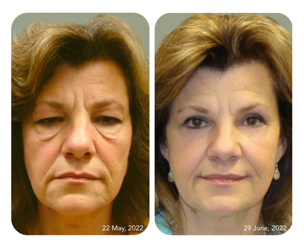 Jorondy Awaken Peptide Lifting Eye Gel