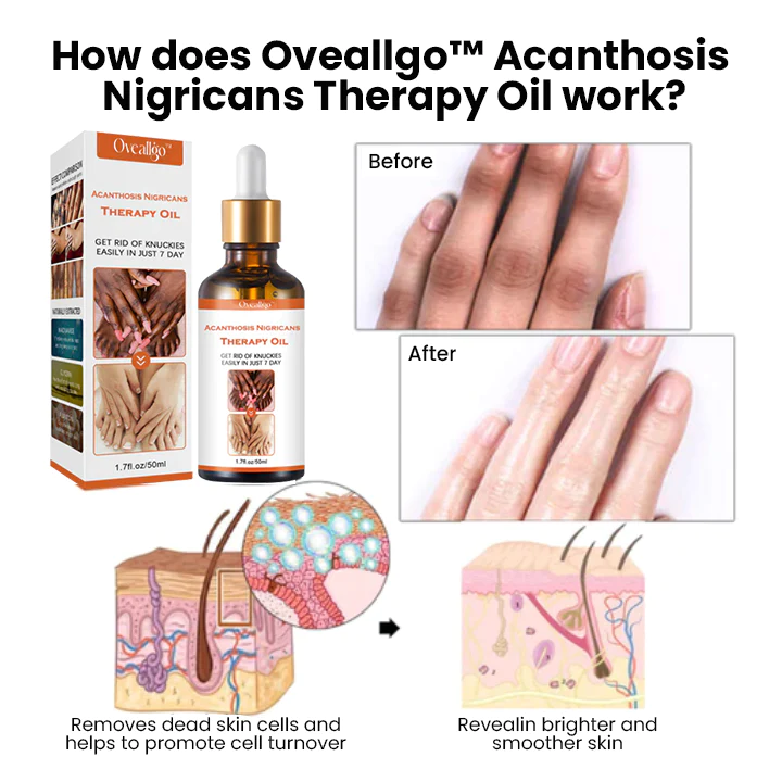 Fivfivgo Acanthosis Nigricans Therapy Oil