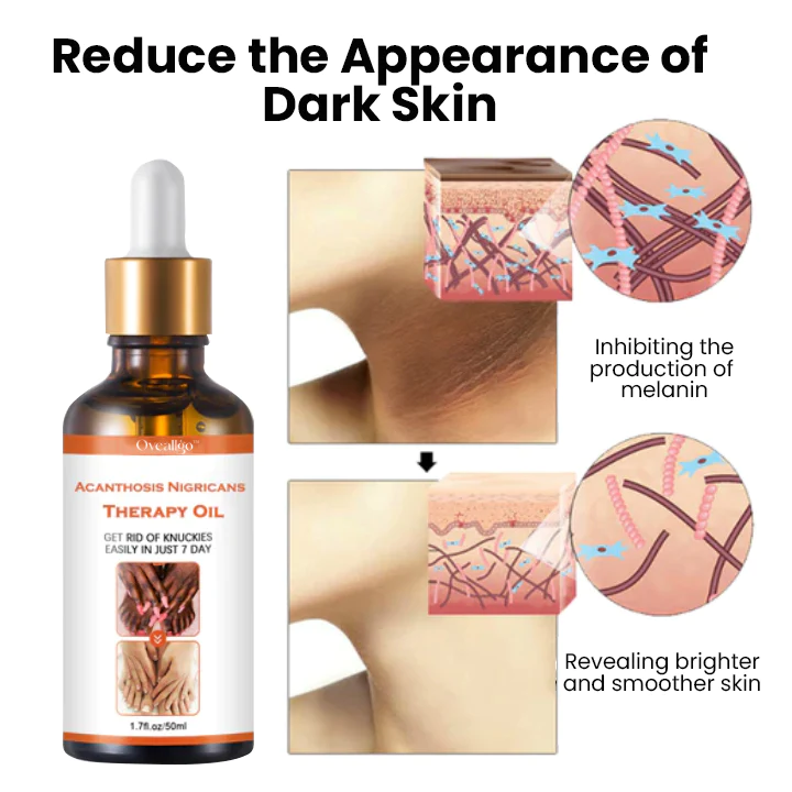 Fivfivgo Acanthosis Nigricans Therapy Oil