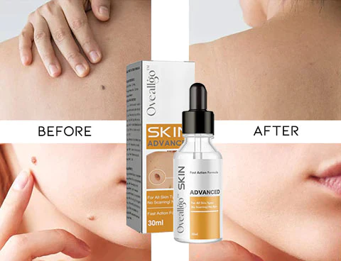 Oveallgo Advanced Skin Tag Clearing Essence