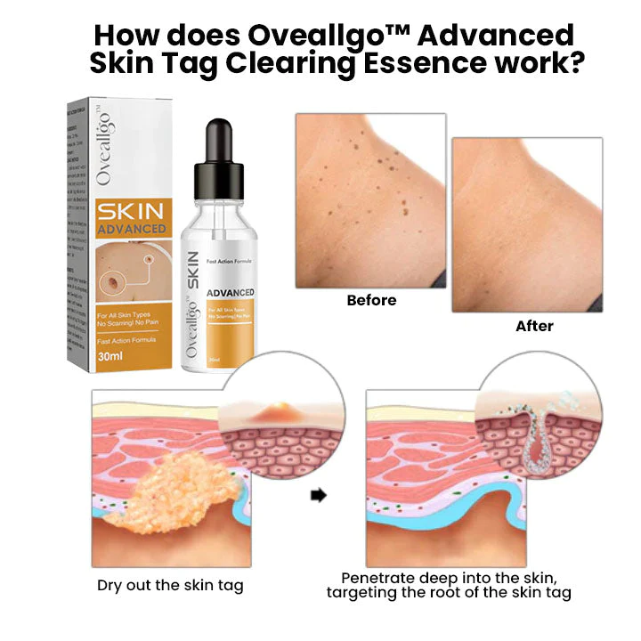 Oveallgo Advanced Skin Tag Clearing Essence