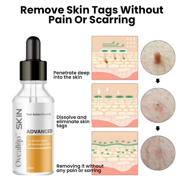 Oveallgo Advanced Skin Tag Clearing Essence
