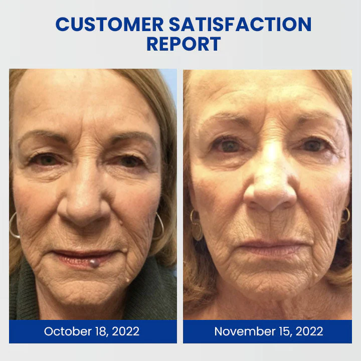 Oveallgo WartsOff Professional Blemish Removal Cream