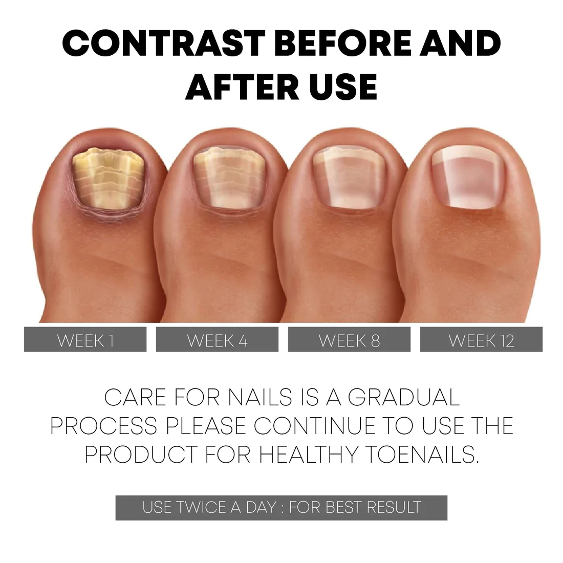 PediPerfect AntiParonychia Relief Oil