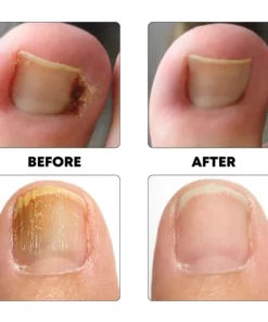 PediPerfect AntiParonychia Relief Oil