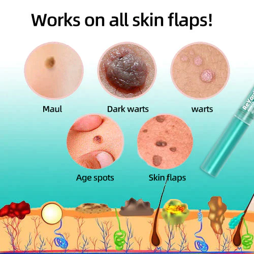 ReYouthBioŽ Tags & Moles Remover