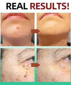 ReYouthBioŽ Tags & Moles Remover