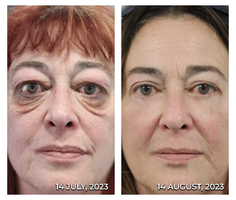 Furzero 24K Gold Snail Firming Eye Patches