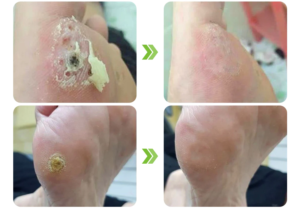 GFOUK IHerbal Foot Callus And Corns Removal Soak
