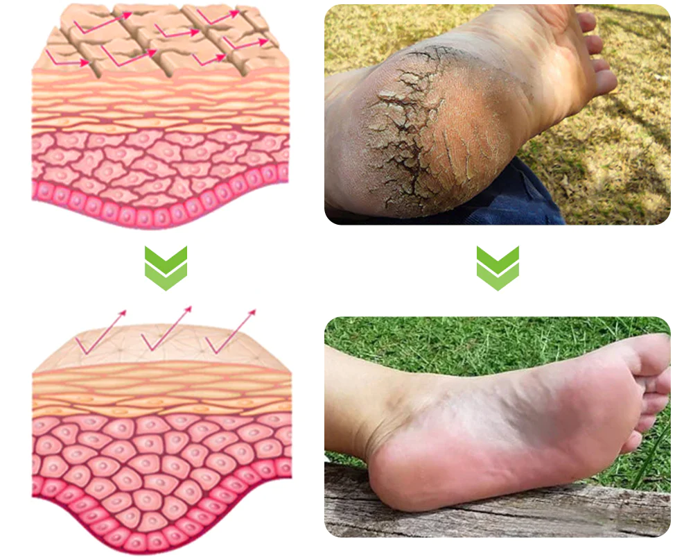 GFOUK IHerbal Foot Callus And Corns Removal Soak