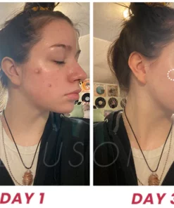 Blusoms Pro AcneAtelier Microneedles Patch