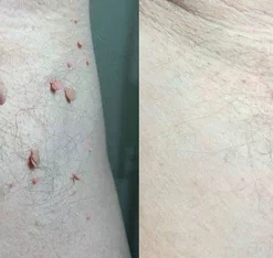 SkinPro Skin Tag Remover Patch