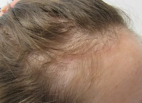 Oveallgo FollicleRX NMN Follicle Reverse Serum