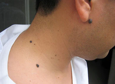 FibrOUT Auto Skin Tag Removal Kit