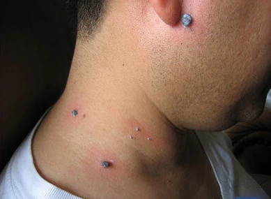 FibrOUT Auto Skin Tag Removal Kit