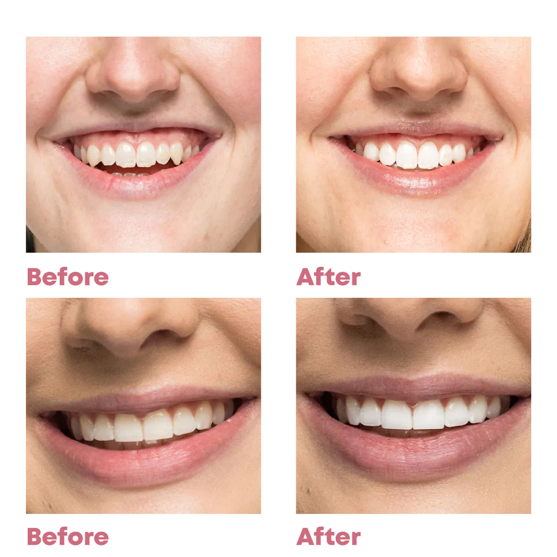 StainRemoval Teeth Whitening Strips