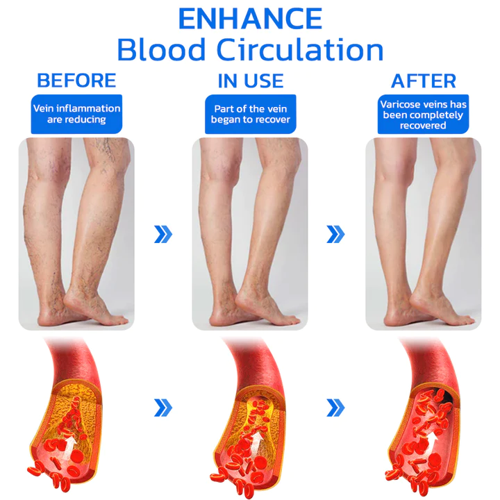 GFOUK Varicesness Treatment Patch