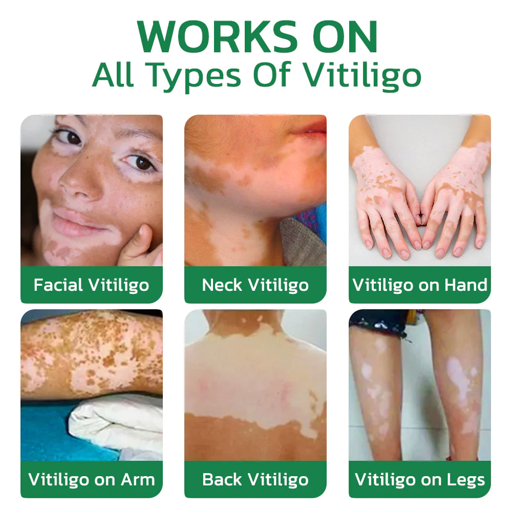 GFOUK TreatVitiligo Soothing Cream