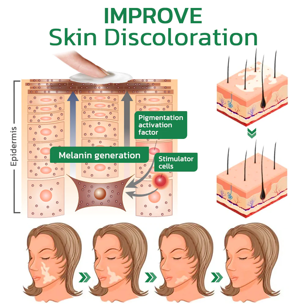 GFOUK TreatVitiligo Soothing Cream