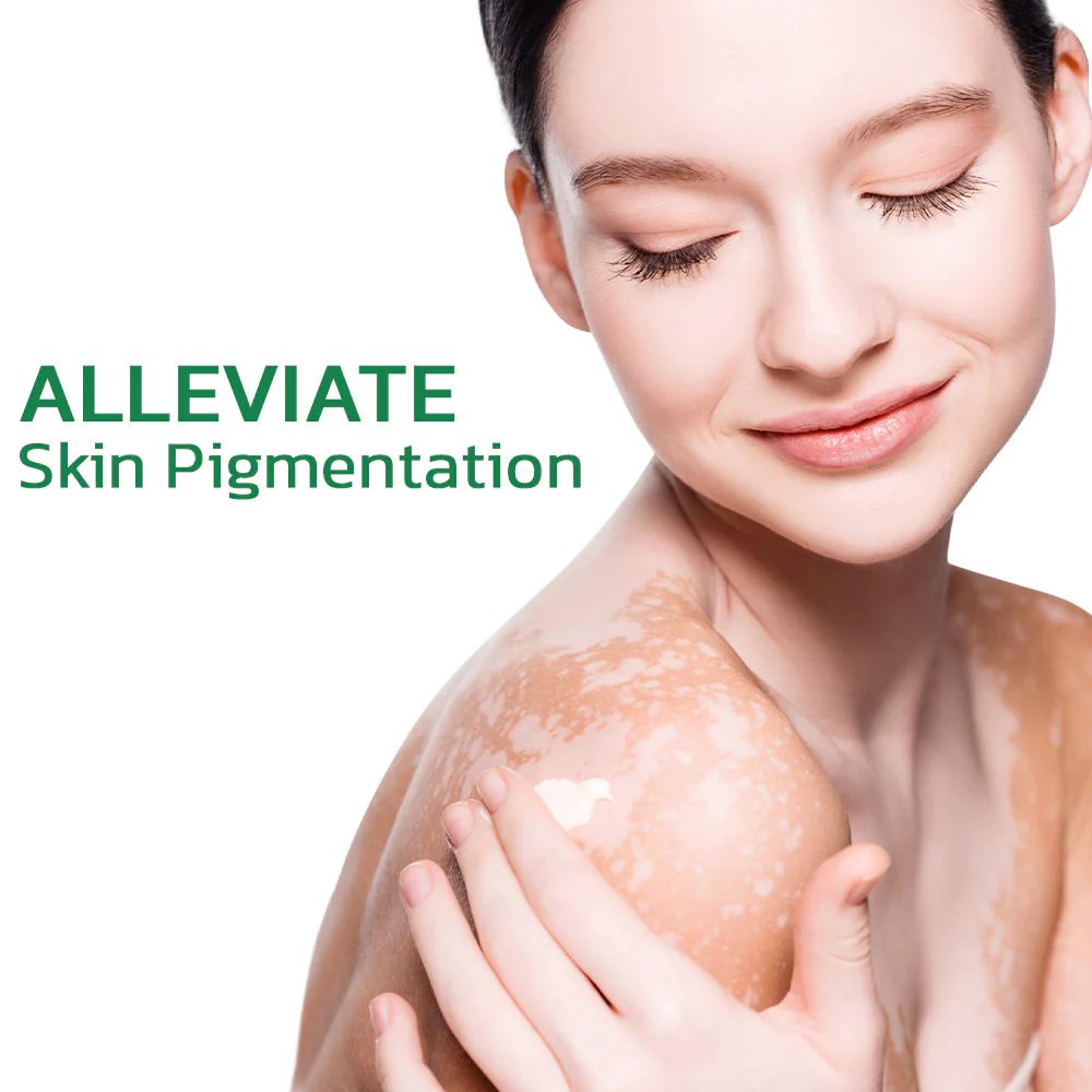 GFOUK TreatVitiligo Soothing Cream