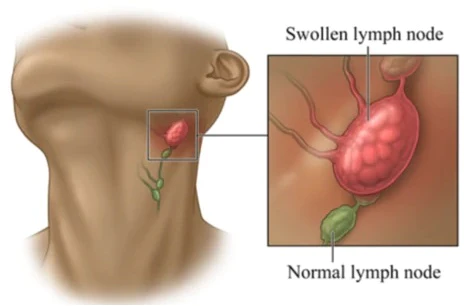 RochFit Lymph Detoxification Ginger Oil