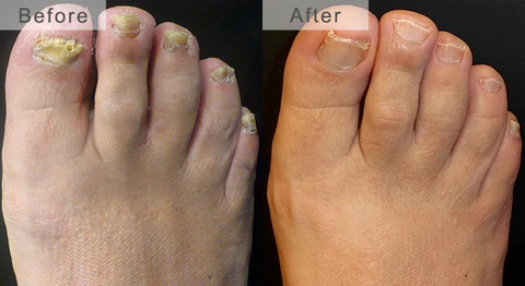 NailSpeed Laser Light Fungal Nail Pen