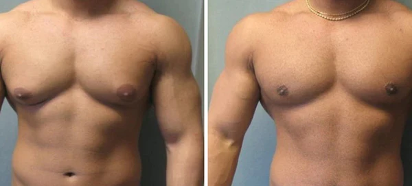 Oveallgo TurmericMax Gynecomastia Compress Patch