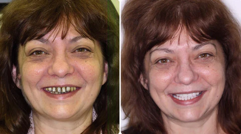 Shark Cartilage Protein & Hydrated Silica Dental Restoration Gel