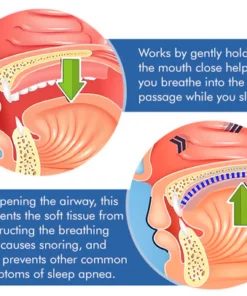 SoundSleep Anti Snoring Stickers