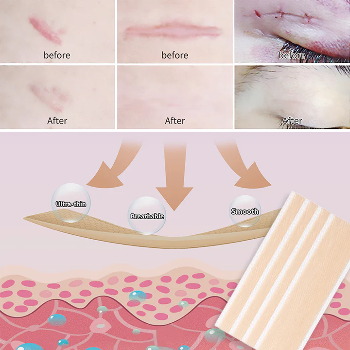 BIOCLEAR Silicone Scar Reduction Sheets